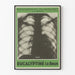 Röntgenposter av lungor - Abscess - Vintage medicinsk väggdekoration
